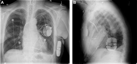 Subcutaneous Implantable Cardioverter Defibrillator Placement In A