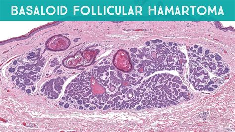 Basaloid Follicular Hamartoma Linear Multiple Mimic Of Basal Cell