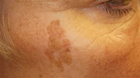 Sunspots On Skin Causes And Treatment Çil Bıyıklar Güneş