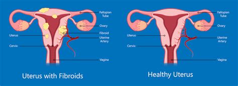 When Life Is Feeling Cramped The Signs And Symptoms Of Uterine Fibroids