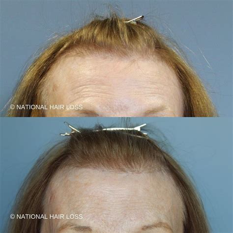 National Hair Loss On Instagram Beautifully Restored Hairline And