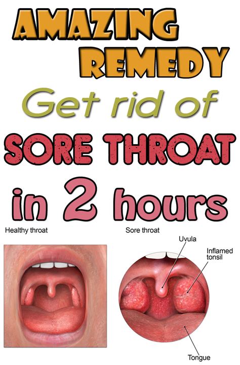Amazing Remedy Get Rid Of Sore Throat In Hours Fitness Shortcut