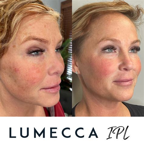 Lumecca Ipl Photofacial Horizon Medical Spa