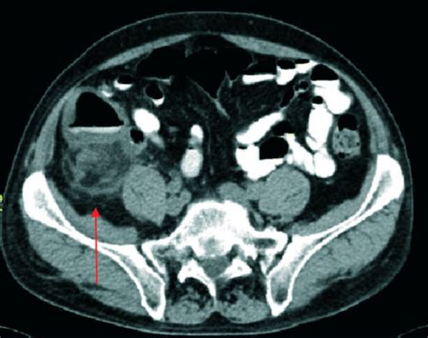 Clinical Cases Abdomen And Pelvis Man 70 Years Old Lower Right