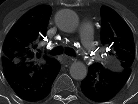 Pulmonary Sarcoidosis Typical And Atypical Manifestations At High
