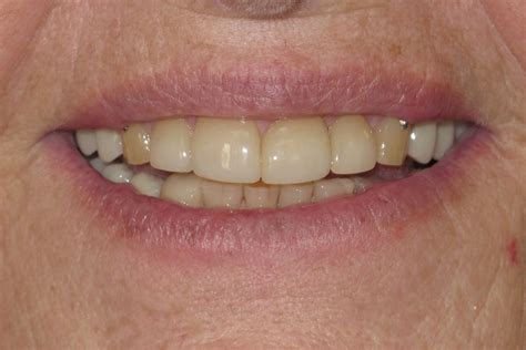 Removable Partial Dentures Smile Gallery Raber Dental Kidron Dentist