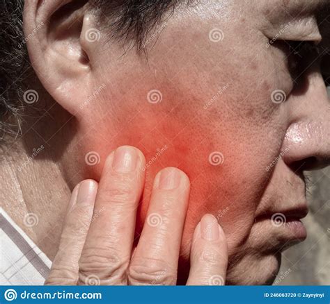 Inflammation At The Cheek Of Asian Patient He Feels Toothache Stock