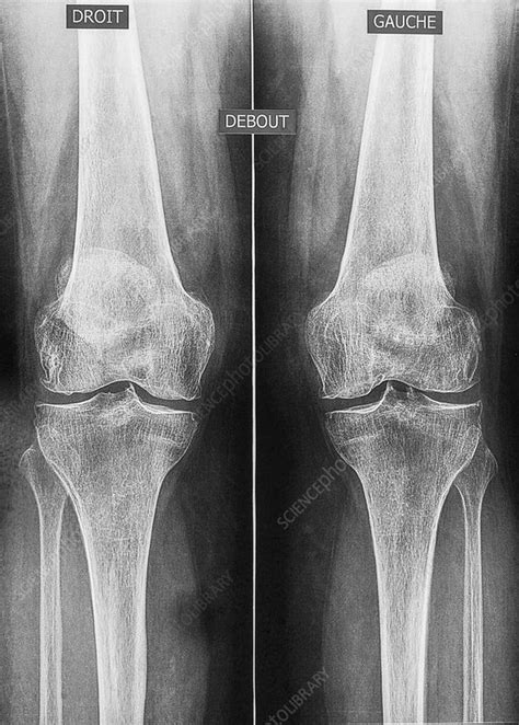Osteoarthritis Of The Knees X Ray Stock Image C0368208 Science