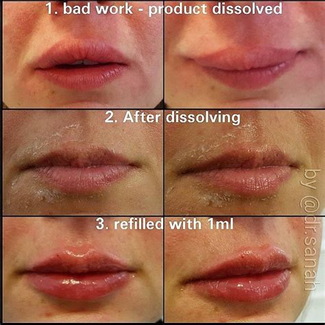 How To Reduce Swelling After Lip Fillers Unugtp News