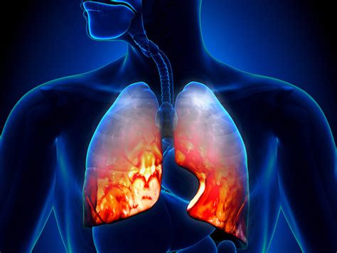acute  respiratory infections strive  good health