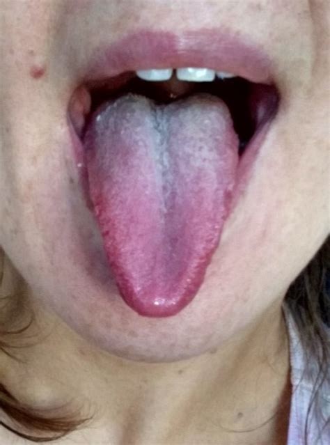 Lyme Out Candida Tongue Check After One Month Of Treatment
