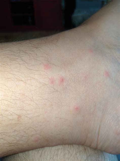 Bed Bug Bites Vs Mosquito Bites Reddit See More On Mekanikal Home Tool