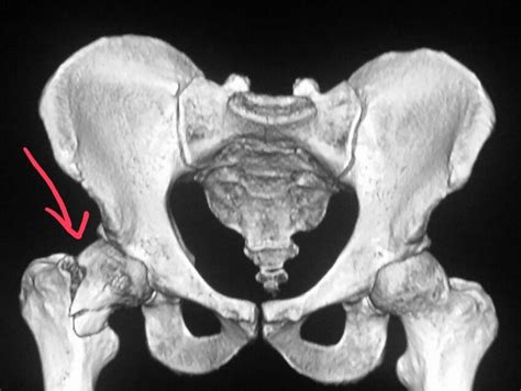 Pelvic Ct Shows A Hip Fracture Femoral Neck In A Patient Who