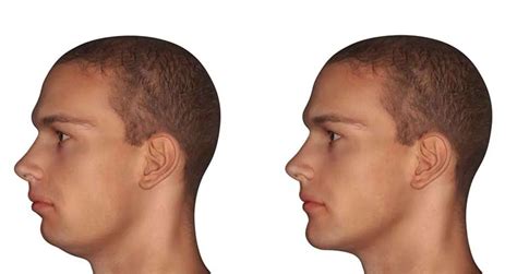 Chin Augmentation Treatments In Chicago Chin Lift Surgical Procedures