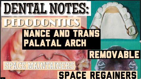 Nance Palatal Arch Ii Trans Palatal Arch Ii Removable Space Maintainers