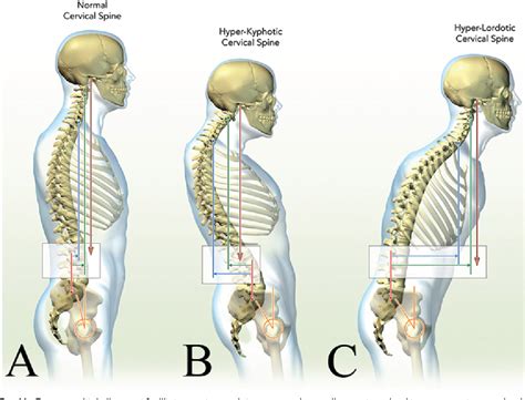 Figure 11 From Cervical Spine Alignment Sagittal Deformity And
