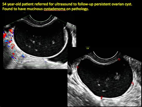 Ovarian Cancer Tumor Ultrasound