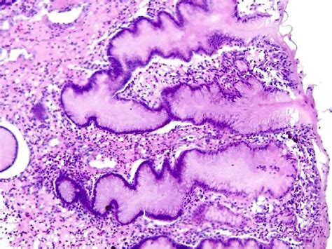 Severe Atrophic Chronic Gastritis He Staining ×100 Download