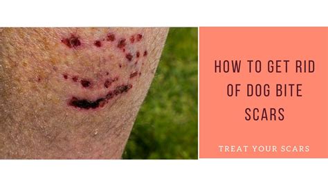 How To Get Rid Of Dog Bite Scars Treat Your Scars