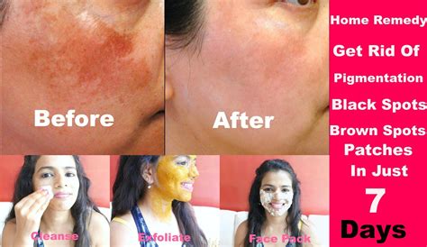 How To Remove Black Spots And Dark Spots On Face Remove Pigmentation