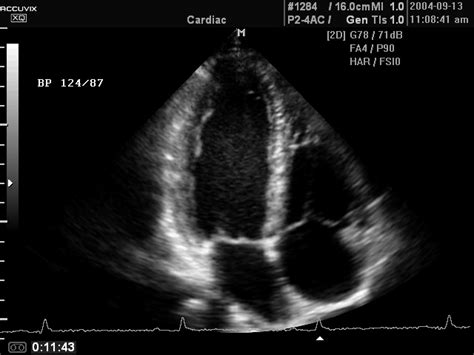 Ultrasound Images Heart 4 Chamber View B Mode Echogramm №359