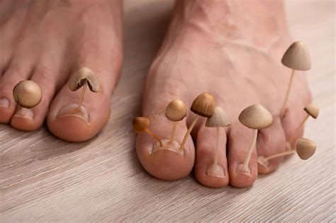 Can You Treat Foot Fungus At Home Hint You Cant Feet First Clinic