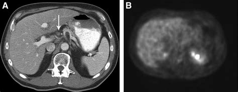 Current Concepts In Lymph Node Imaging Journal Of Nuclear Medicine