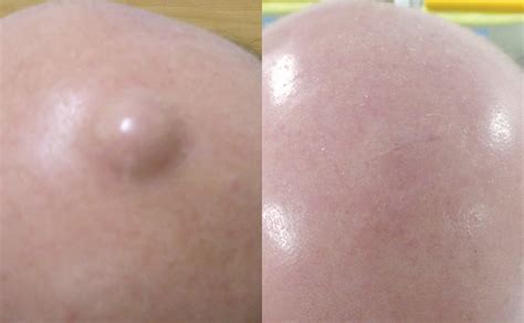 Cyst Removal From £350 Leeds Bradford Harrogate Skin Surgery Clinic