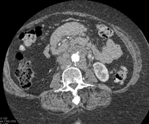 Bulky Subcrural Nodes In A Patient With Lymphoma Chest Case Studies