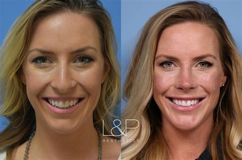 Rhinoplasty Before And After Chin Implant Neck Lift Jaw Line Contouring