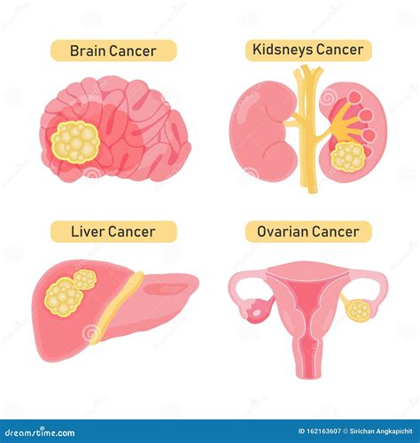 Types Of Ovarian Cysts Set Infographics Vector Illustration On