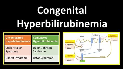 Congenital Hyperbilirubinemia Crigler Najjar Syndromegilbert