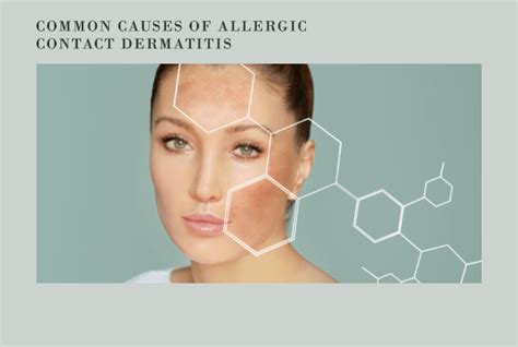 Common Causes Of Allergic Contact Dermatitis