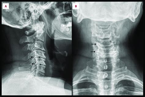 Cervical Spine Radiographs Lateral View A And Anteroposterior View