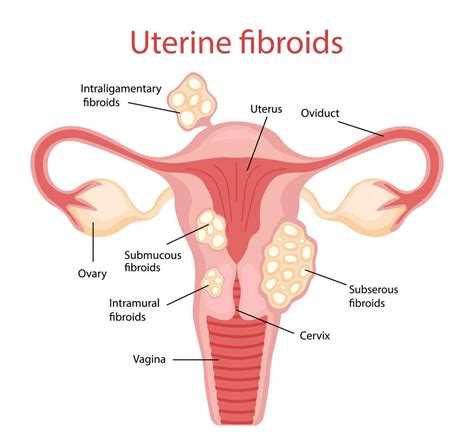 Fibromas Enfermedades Del Aparato Reproductor Femenino Ilustraci N