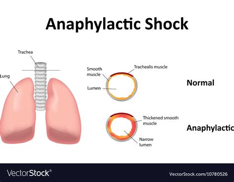 Anaphylactic Shock Lungs Royalty Free Vector Image