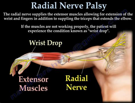 Radial Nerve Nerve Palsy Radial Nerve Nerve