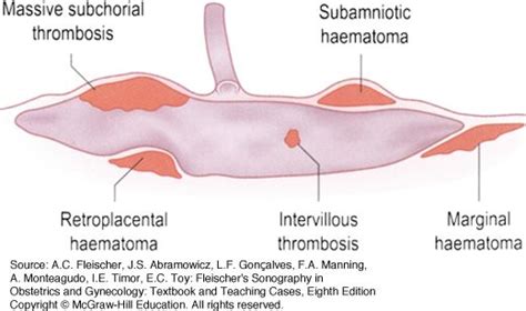 Resultado De Imagen Para Subamniotic Hematoma Ultrasonido