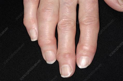 Osteoarthritis Of The Fingers Stock Image C0042453 Science Photo