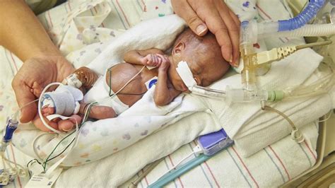El Bebé Más Prematuro Del Mundo Cumple Tres Años Sin Problemas Graves