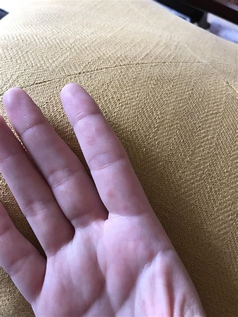 Skin Concerns Does Anyone Know What These Red Bumps Are
