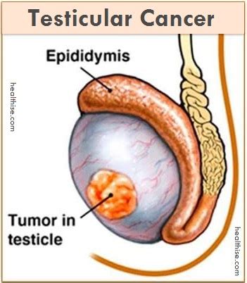 Tetanus in pets (lock jaw) the wrath of grapes. Know Your Testicles: How to Test Your Balls? - Healthise.com™