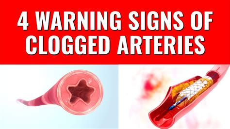 4 Warning Signs Of Clogged Arteries Youtube