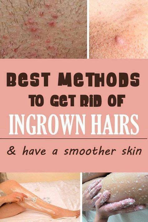 How To Get Rid Of Red Bumps Ingrown Hairs In The Bikini Area