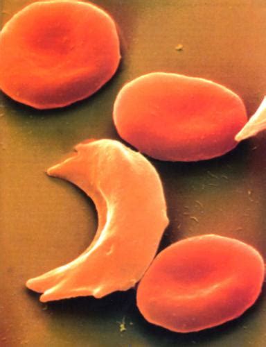 Hemoglobin is a protein in red blood cells that carries oxygen. Sickle Cell Anemia | The Black Past: Remembered and Reclaimed