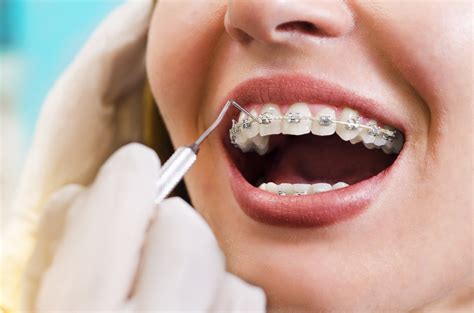 Arch Braces And How They Work Orthodontics In London