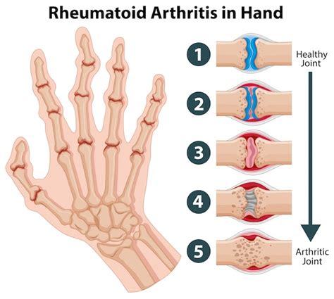 Diagram Showing Rheumatoid Arthritis In A Hand Vector Free Download