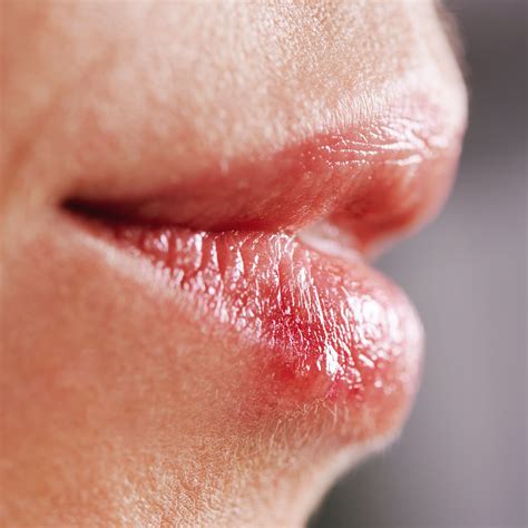 Sunburned Lips Here S What Doctors Say You Should Do The Healthy