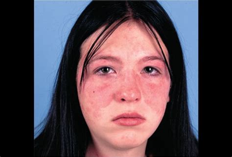 Picture Of Acute Systemic Lupus