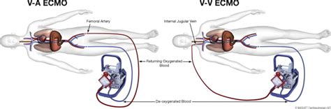 Overview Of Extracorporeal Membrane Oxygenation In Cardiogenic Shock